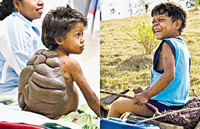 Guías de televisión. Un milagro para Didier. El pequeño colombiano, Didier Montalvo, ‘niño tortuga’, tenía su espalda cubierta como un caparazón, pero ahora puede vivir una vida normal gracias a un cirujano británico que extirpó el tumor.